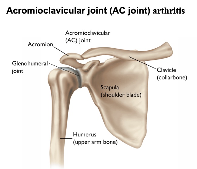 Acromioclavicular Joint Prominence Acromioclavicular Joint Prominence