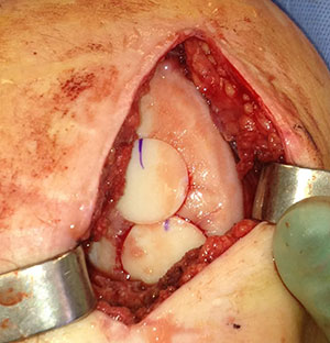 Knee medial femoral condyle lesion treated with fresh osteochondral allograft plugs.