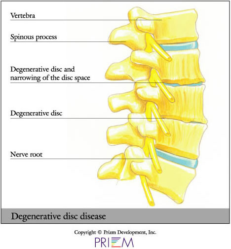 Degenerative Spine Conditions