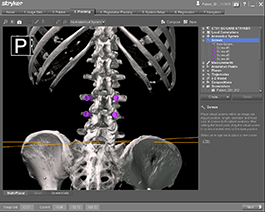 spine navigation technology for spine surgery in rhode island, 3d imaging used by spine surgeons during surgery
